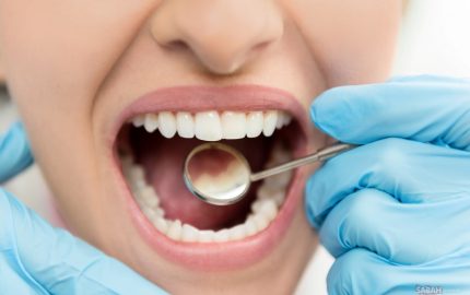 Diş Çürüğü Tedavisi Nasıl Olur?