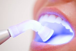 Diş Beyazlatma Estetiği